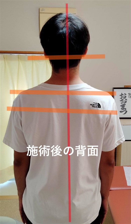 Posture check — after treatment, back view
