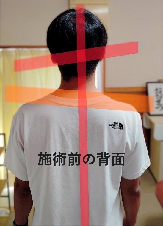 Posture check — before treatment, back view